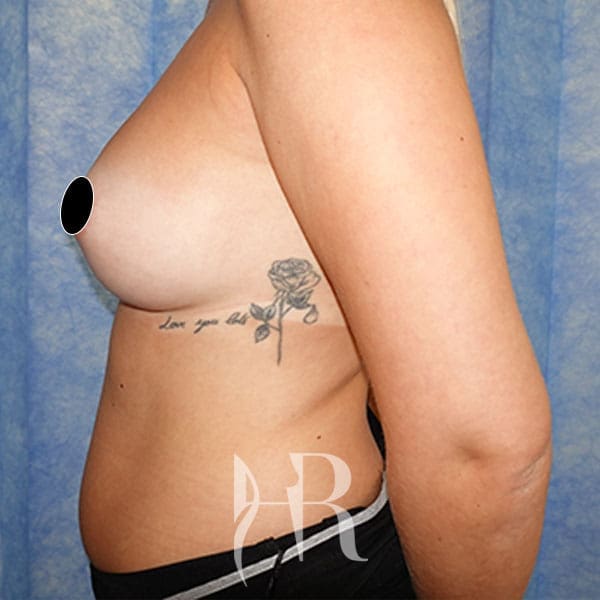 HR Plastic Surgery - Breast Enlargement patient after 8
